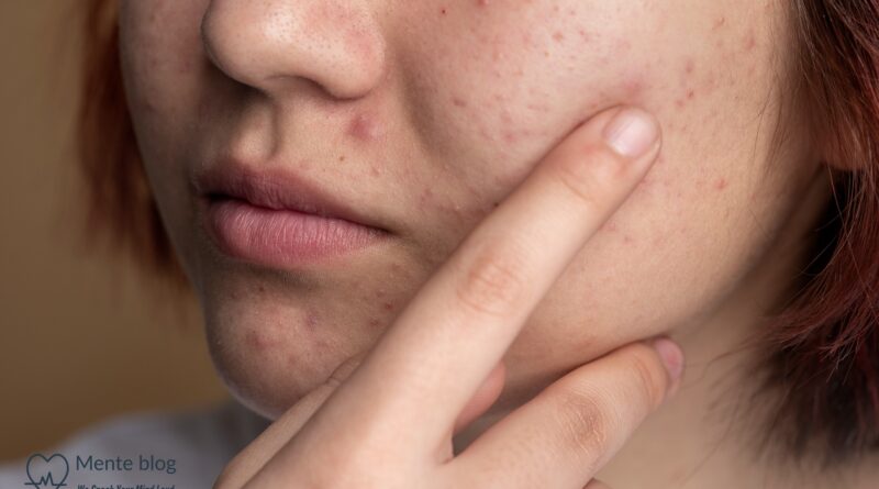 how to treat acne